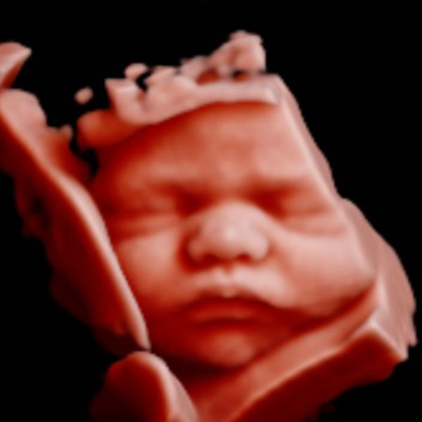 4D/HD Ultrasound